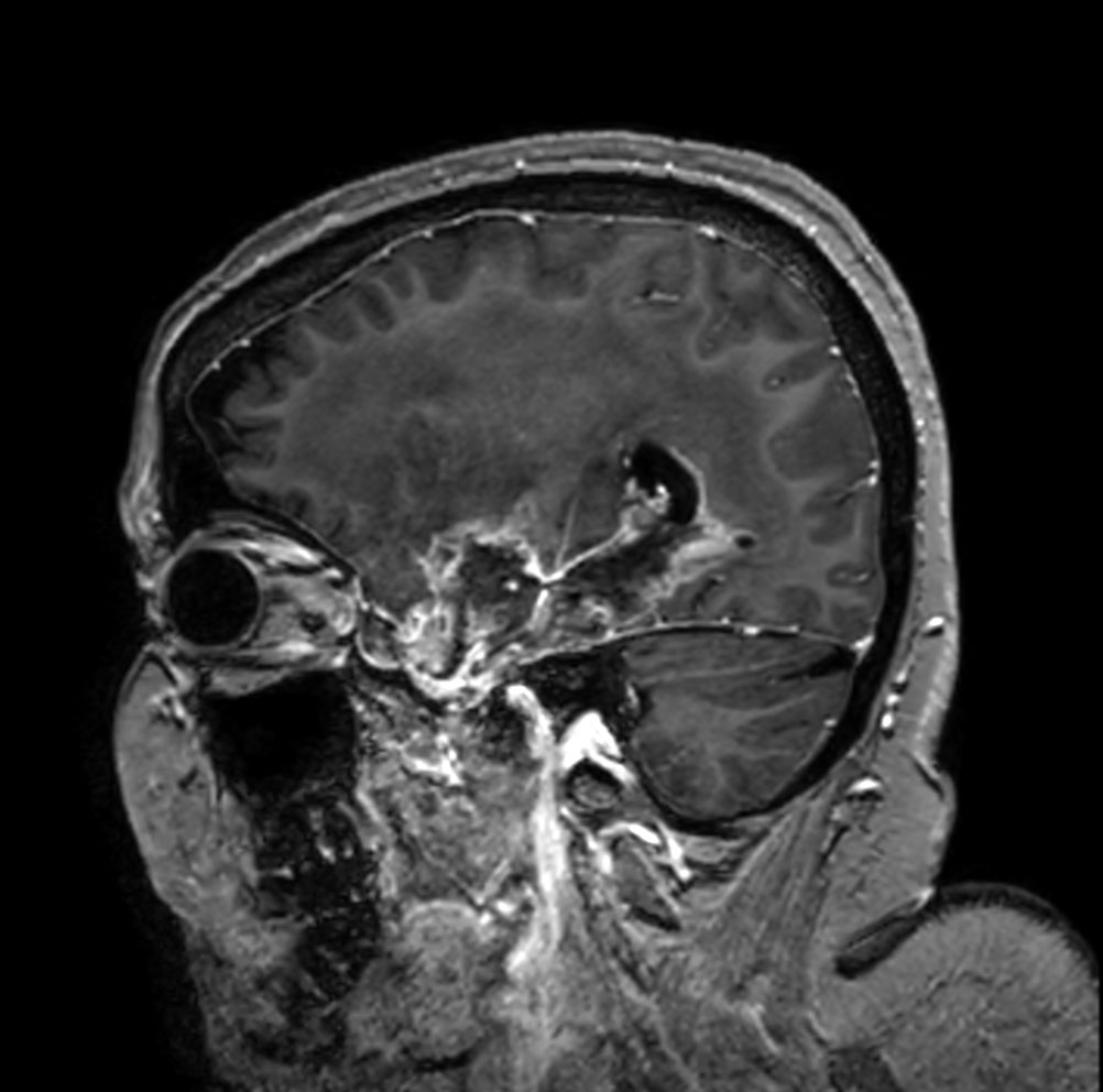 Sagittal T1w 3D TFE with gado