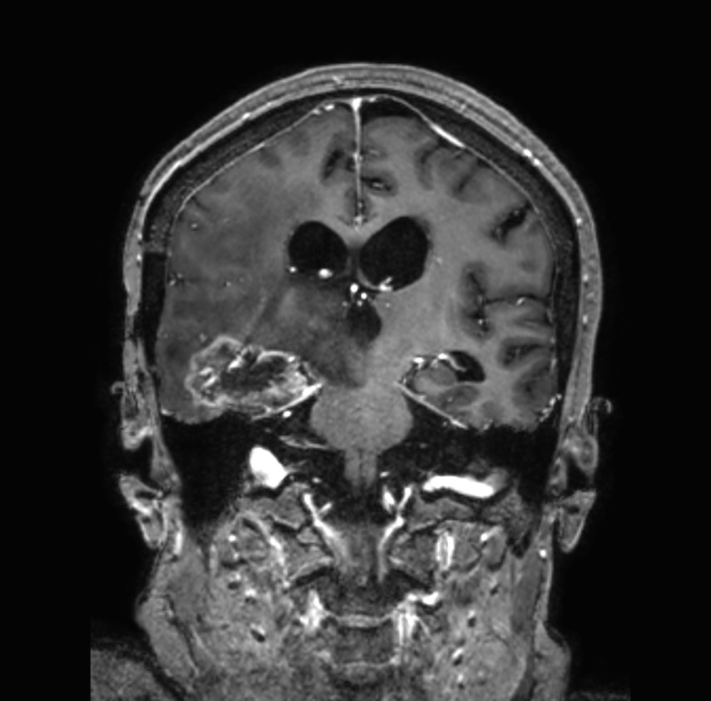 T1w 3D TFE with gado (coronal reformat)