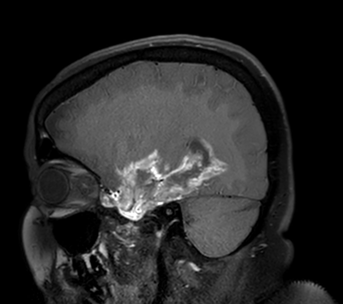 Sagittal 3D BrainVIEW Black Blood