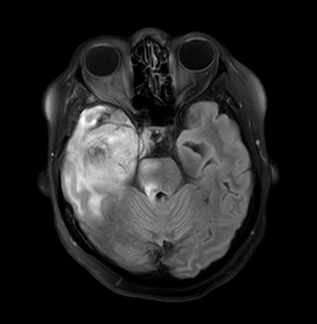 Axial T2w FLAIR