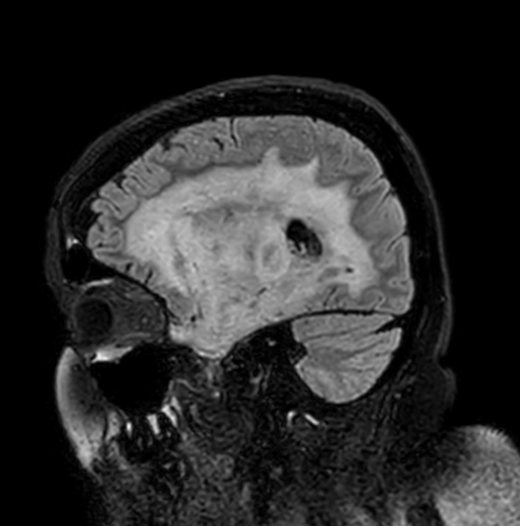 Sagittal 3D BrainVIEW FLAIR