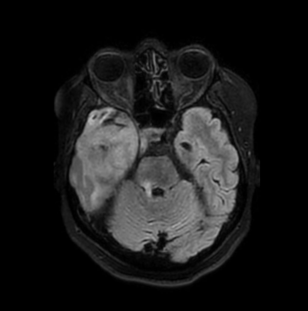 3D BrainVIEW FLAIR (axial reformat)