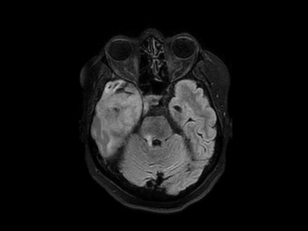 3D BrainVIEW FLAIR (axial reformat)