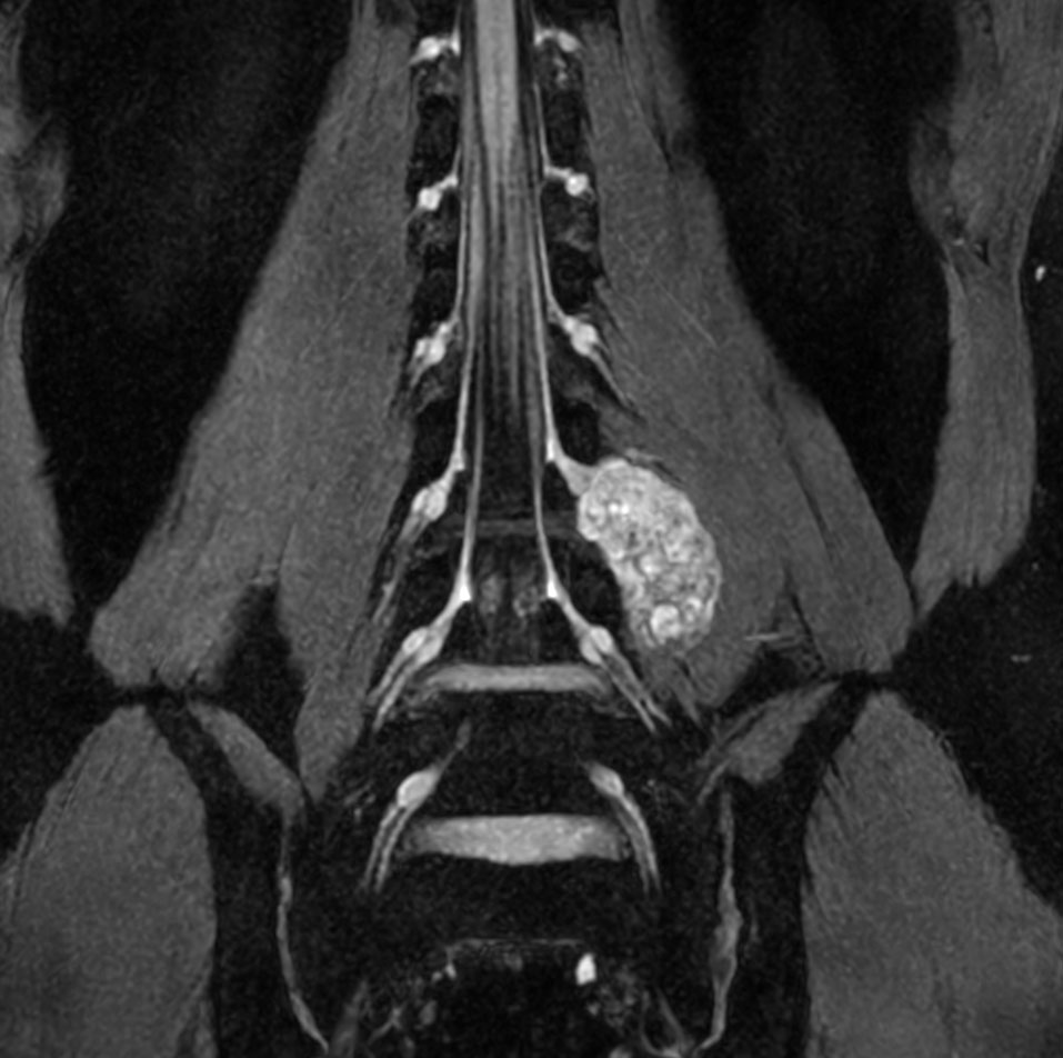 Neurography T2w FFE (MIP) (without Compressed SENSE)