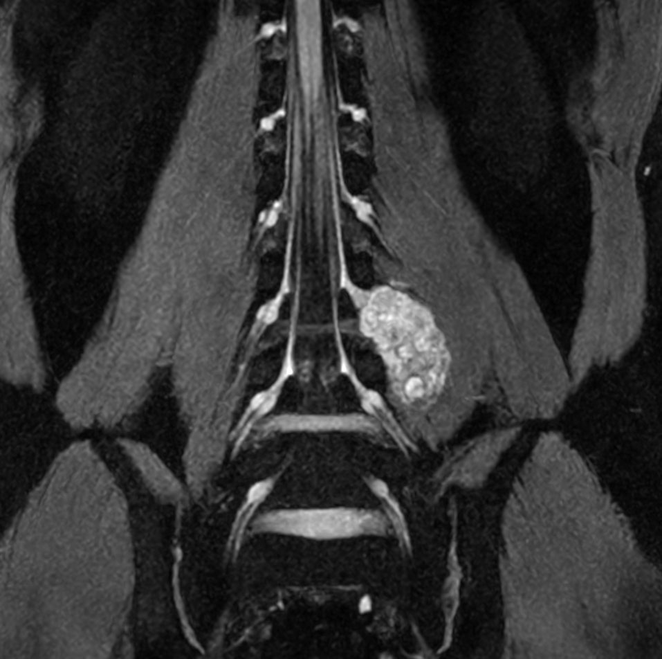 Neurography T2w FFE (MIP) (with Compressed SENSE)