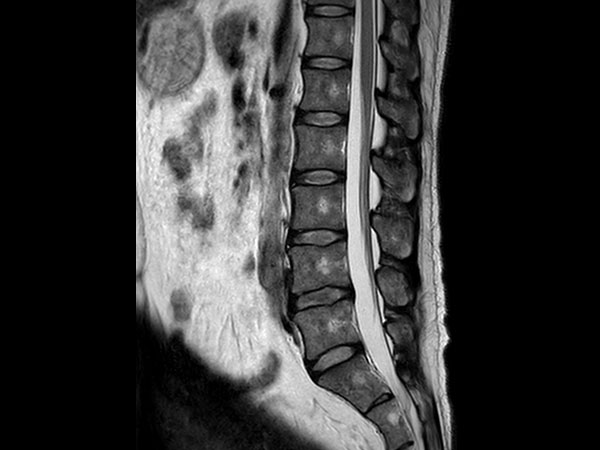 Sagittal T2w TSE