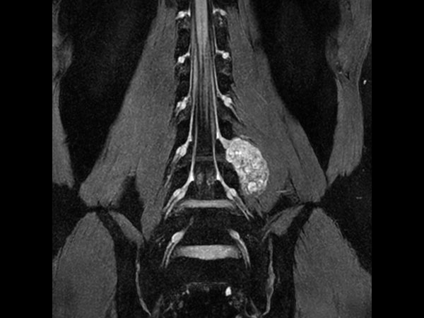 Neurography T2w FFE (MIP) (without Compressed SENSE)