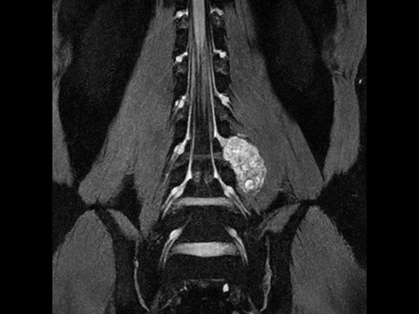 Neurography T2w FFE (MIP) (with Compressed SENSE)