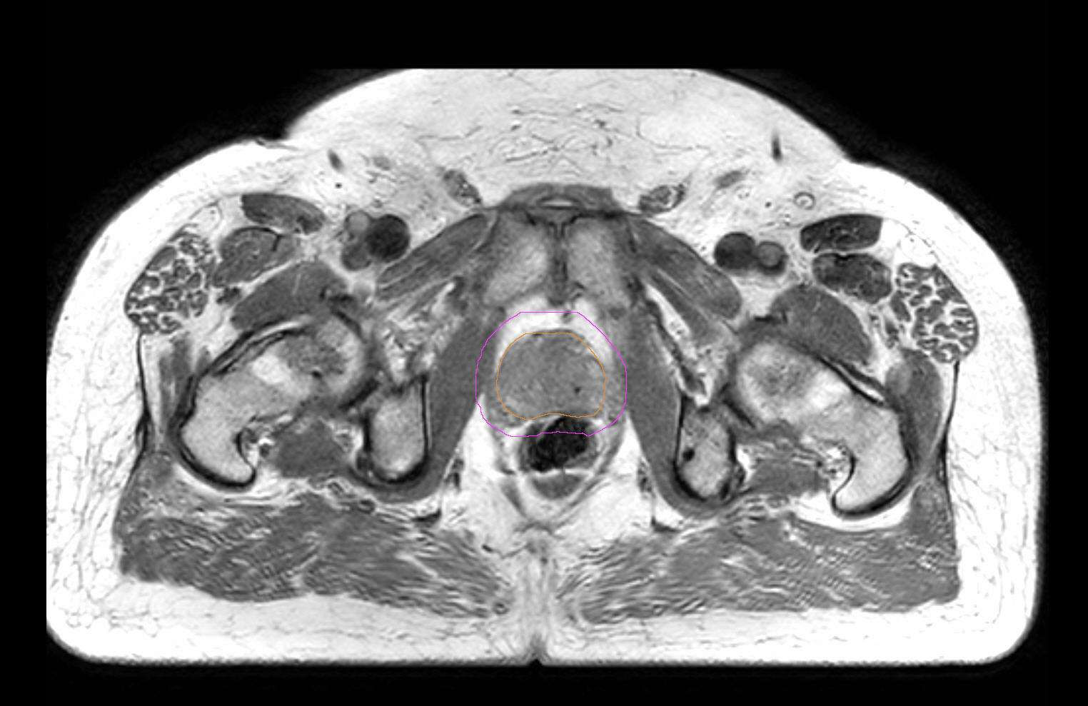 Axial 3D b-FFE marker scan