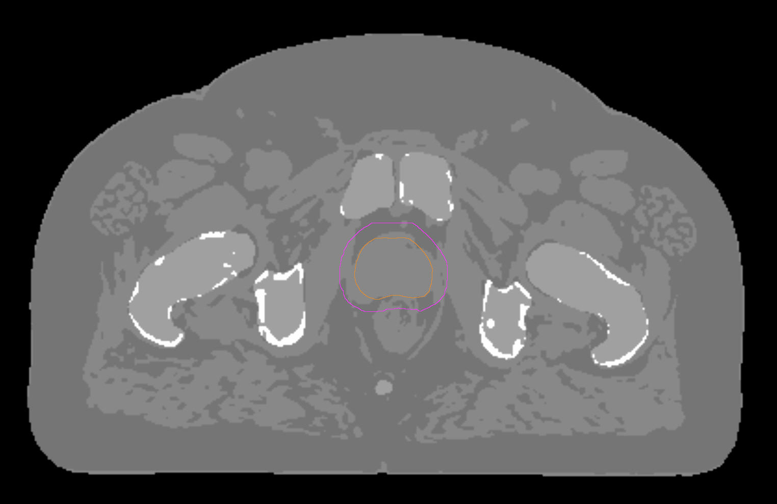MRCAT (Synthetic CT)