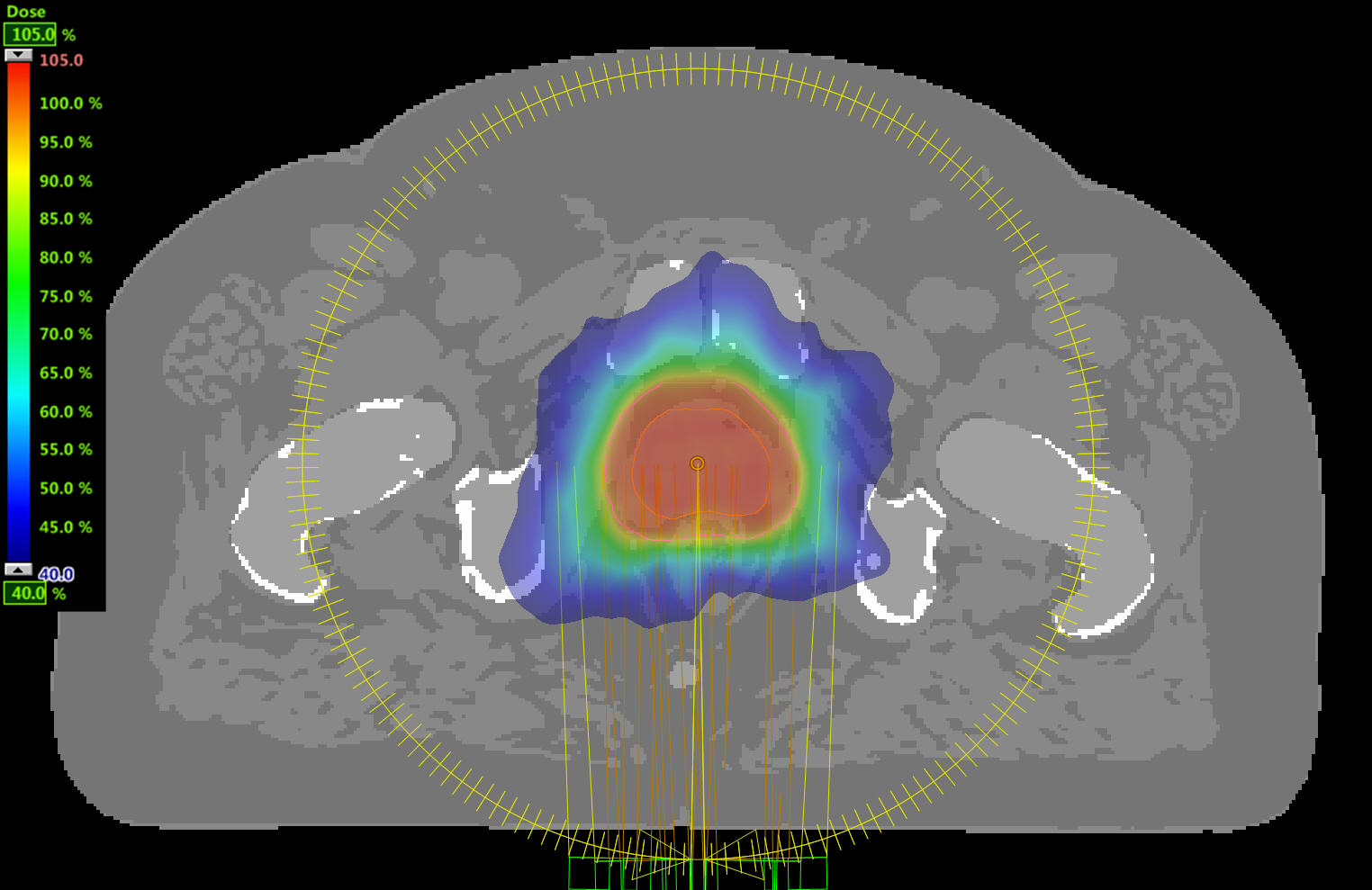 MRCAT-based dose plan