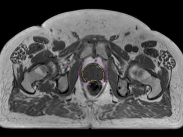 Axial 3D T1W mDIXON FFE in-phase