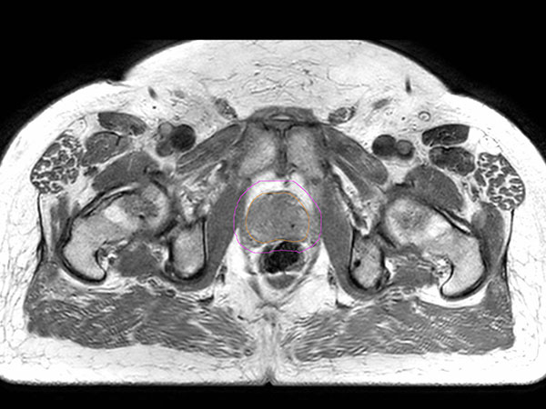 Axial 3D b-FFE marker scan