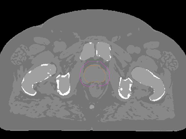 MRCAT (Synthetic CT)