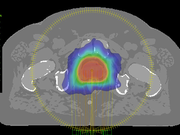 MRCAT-based dose plan