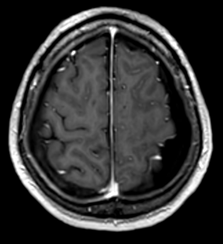Axial 3D T1W FFE post contrast