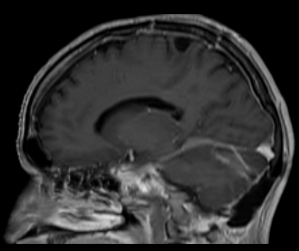 3D T1W FFE post contrast (sagittal reformat)