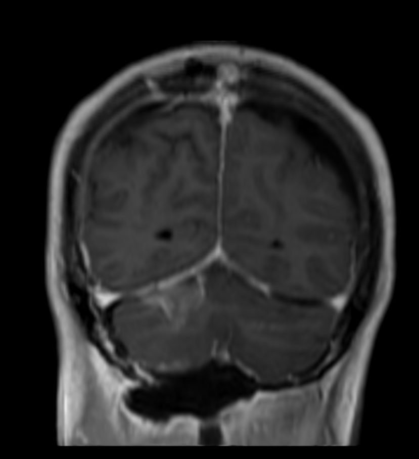 3D T1W FFE post contrast (coronal reformat)