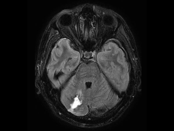 Axial T2W 3D FLAIR