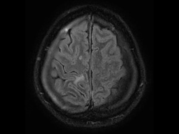 Axial T2W 3D FLAIR