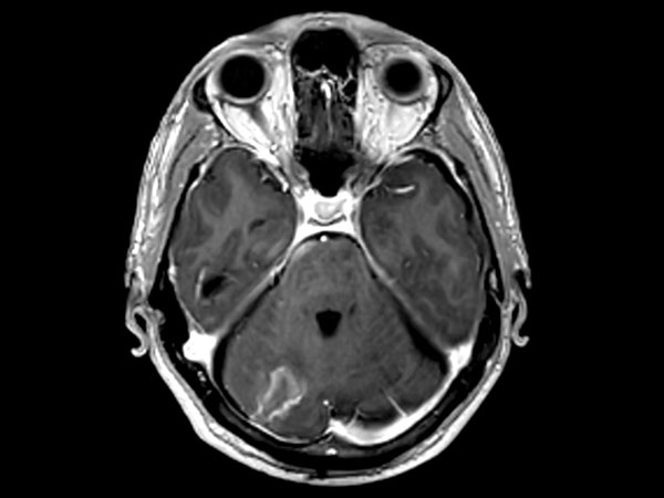 Axial 3D T1W FFE post contrast