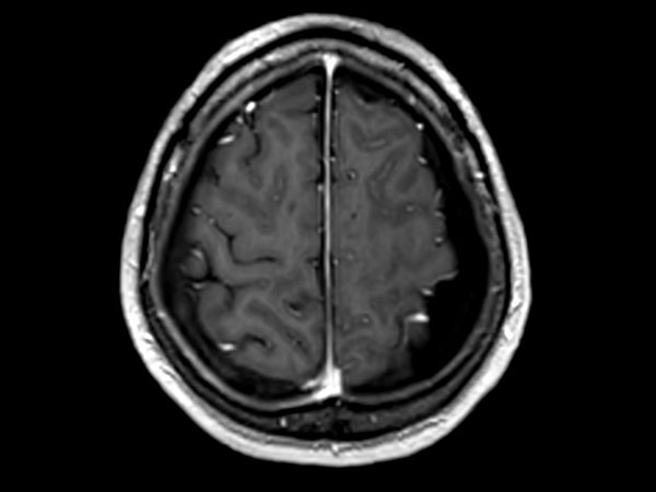 Axial 3D T1W FFE post contrast