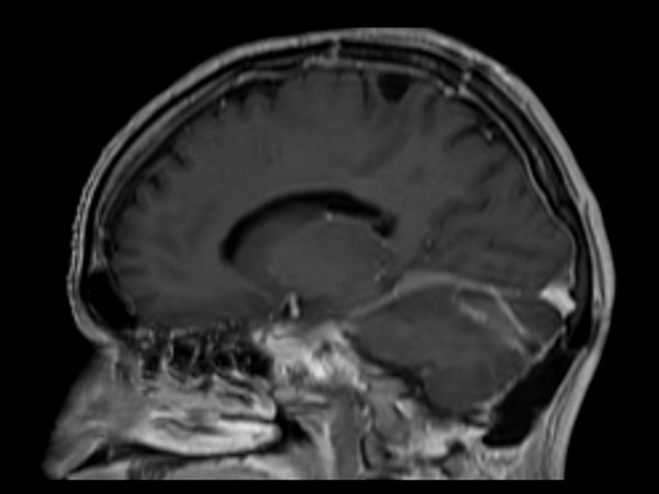 3D T1W FFE post contrast (sagittal reformat)