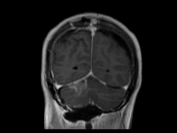 3D T1W FFE post contrast (coronal reformat)