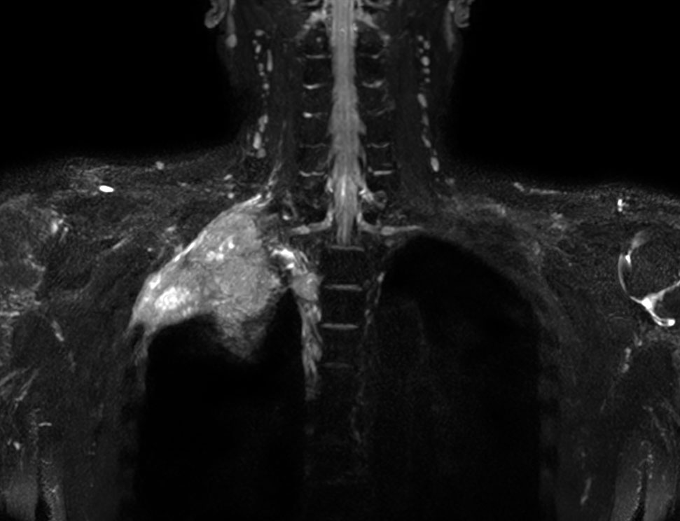 Coronal 3D NerveVIEW (MIP)