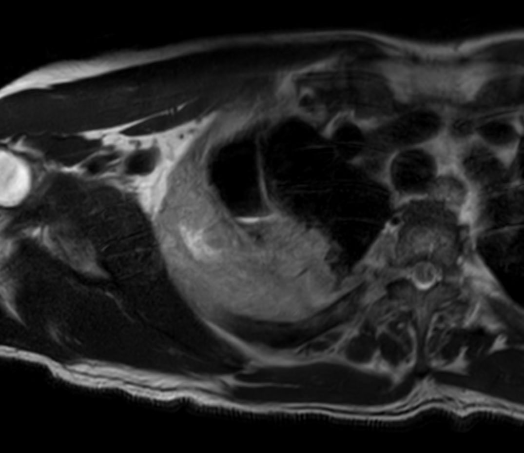 Axial T2w mDIXON XD TSE (In Phase)
