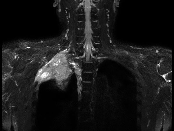 Coronal 3D NerveVIEW (MIP)