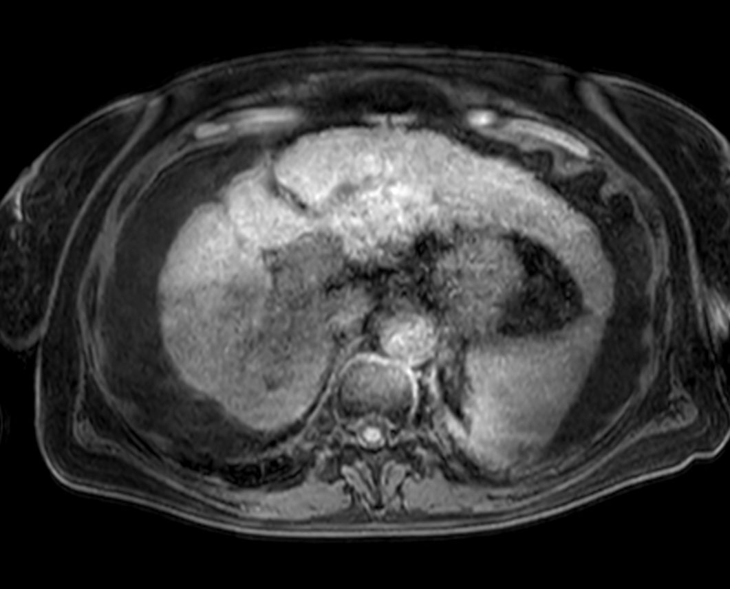 Axial dynamic T1w mDIXON XD FFE (blanco)