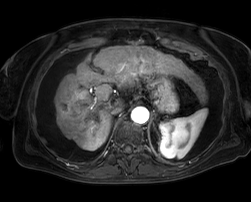 Axial T1w mDIXON XD FFE (1st dynamic)