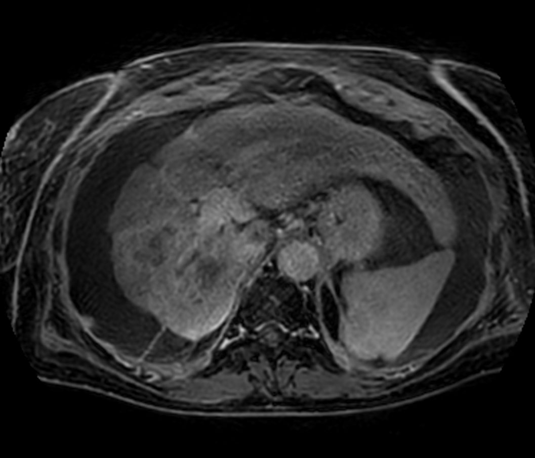 Axial T1w mDIXON XD FFE - post gado (high res)