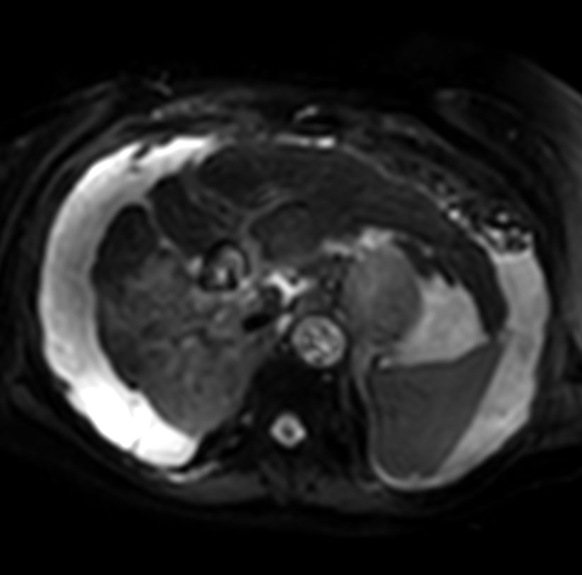 Axial Diffusion - b0