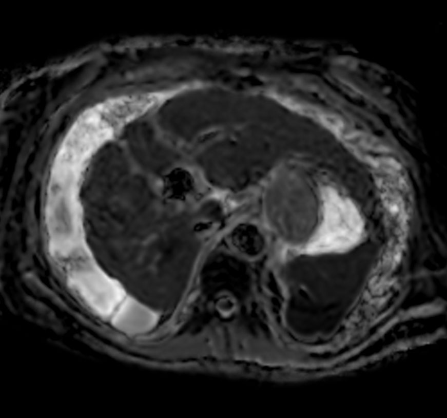 Axial Diffusion - ADC