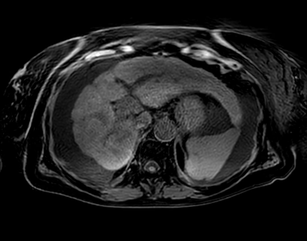 Axial T1w 3D VANE XD (Water only)