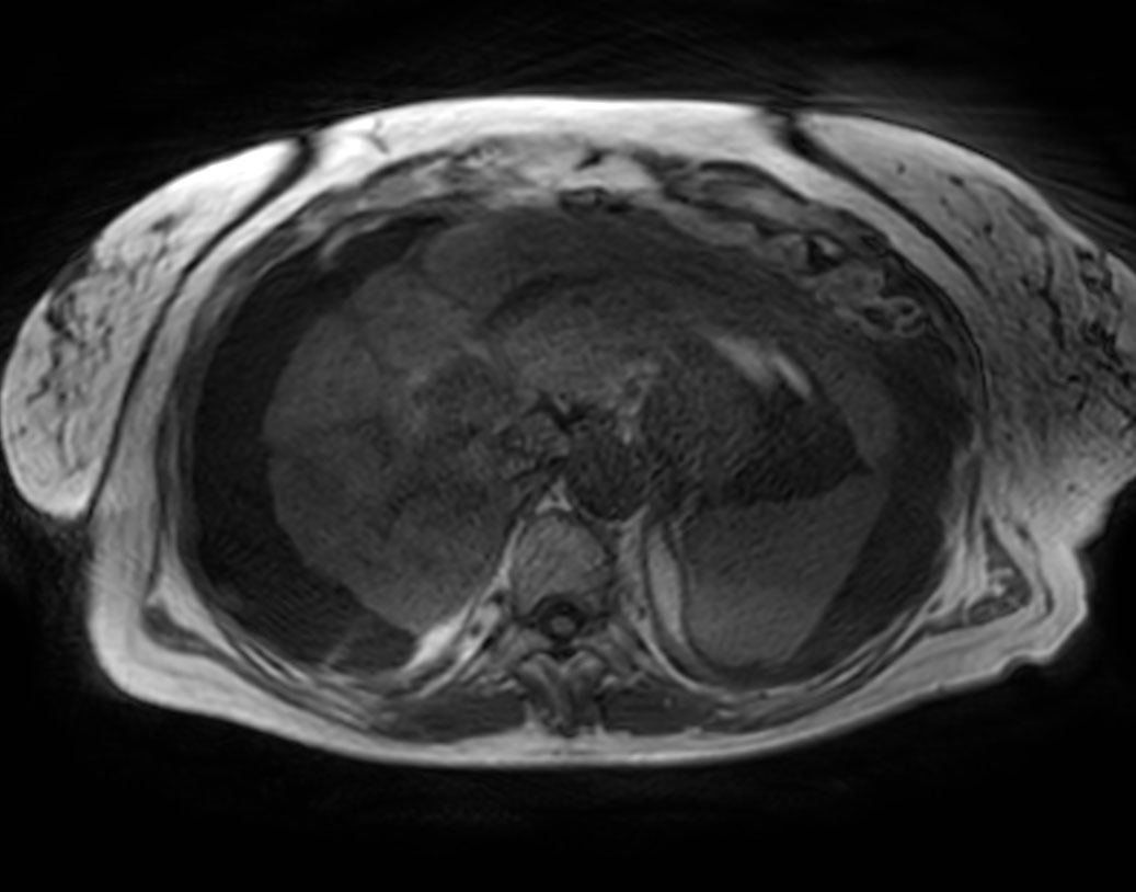Axial T1w 3D VANE XD (In Phase)
