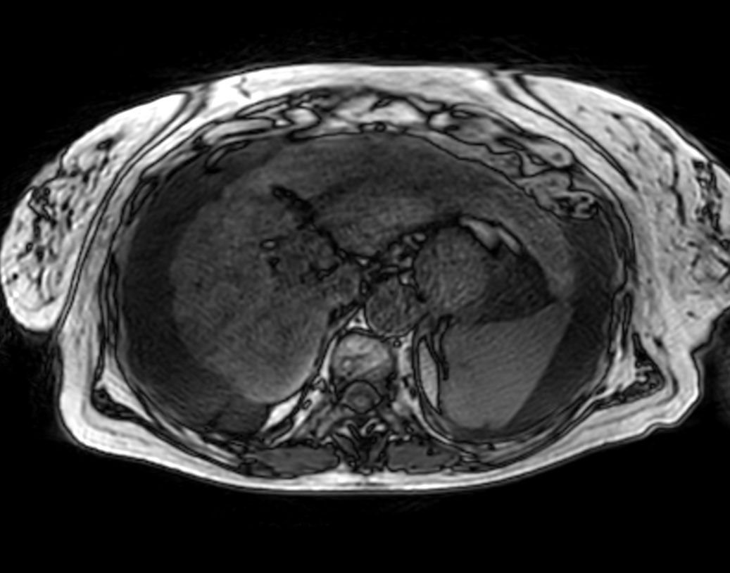 Axial T1w 3D VANE XD (Out Phase)