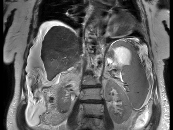 Coronal T2w SSh