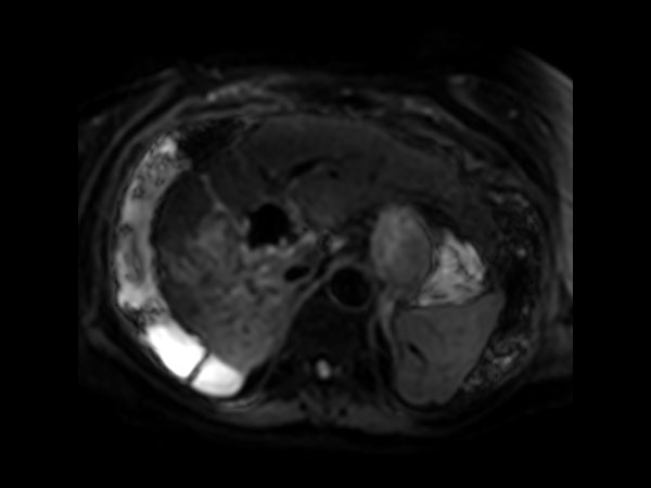 Axial Diffusion - b50