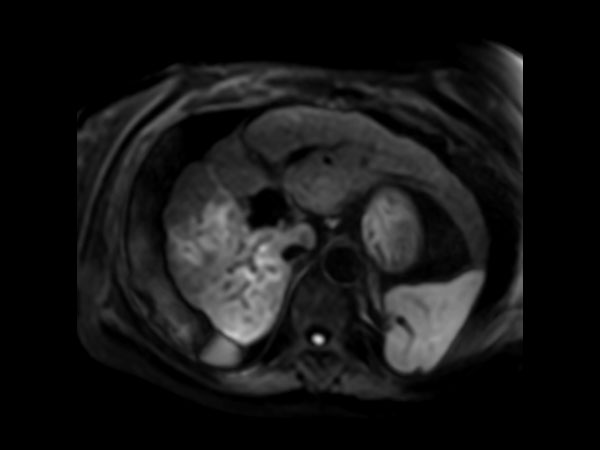 Axial Diffusion - b600