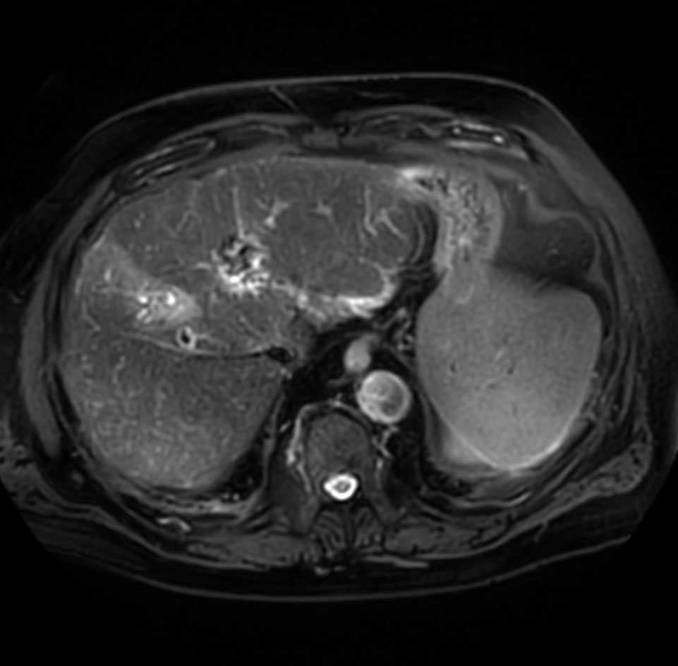 Axial T2w SPAIR - MultiVane XD