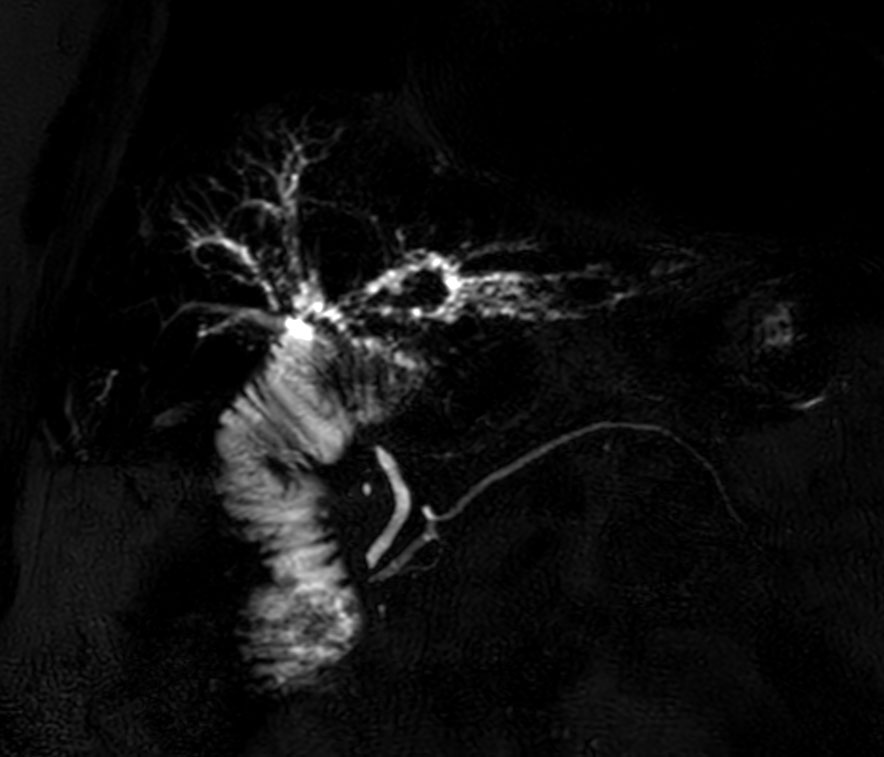 MRCP SSh - 15 radial slices