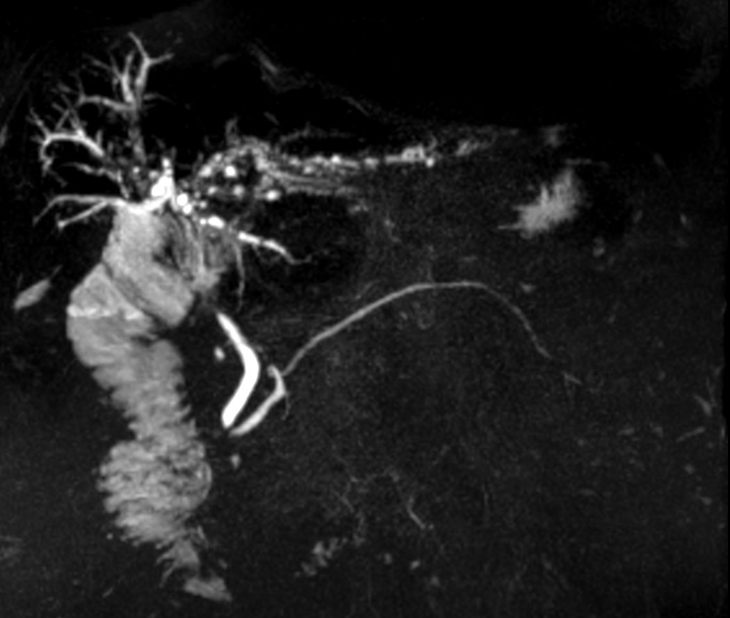 Coronal MRCP 3D - Compressed SENSE