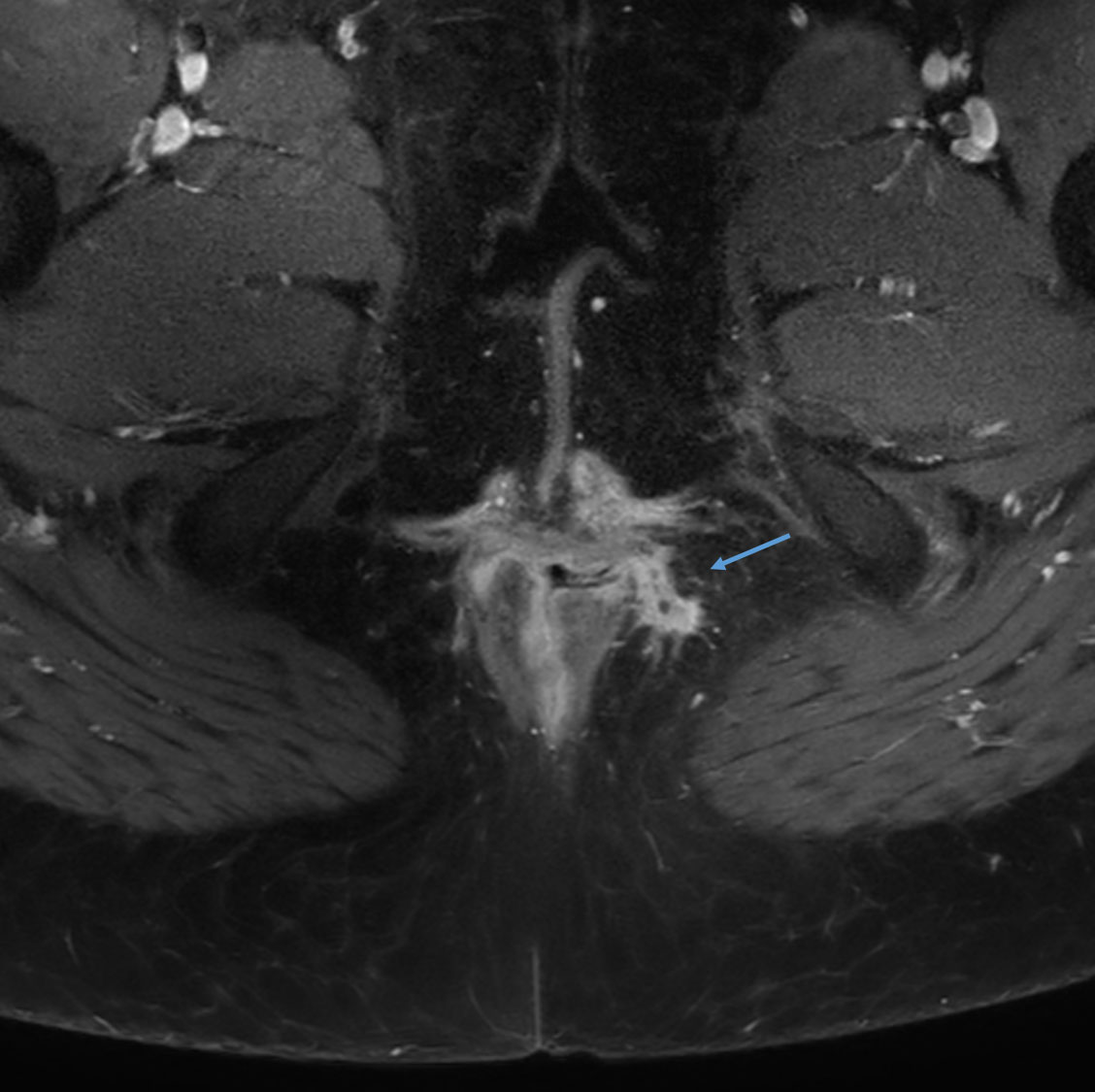 Axial T1w SPIR with gado