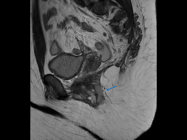 Sagittal T2w TSE