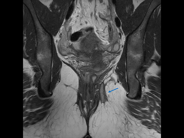 Coronal T2w TSE 