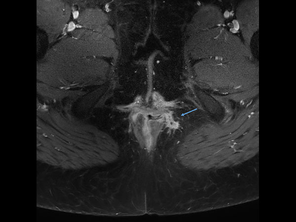 Axial T1w SPIR with gado