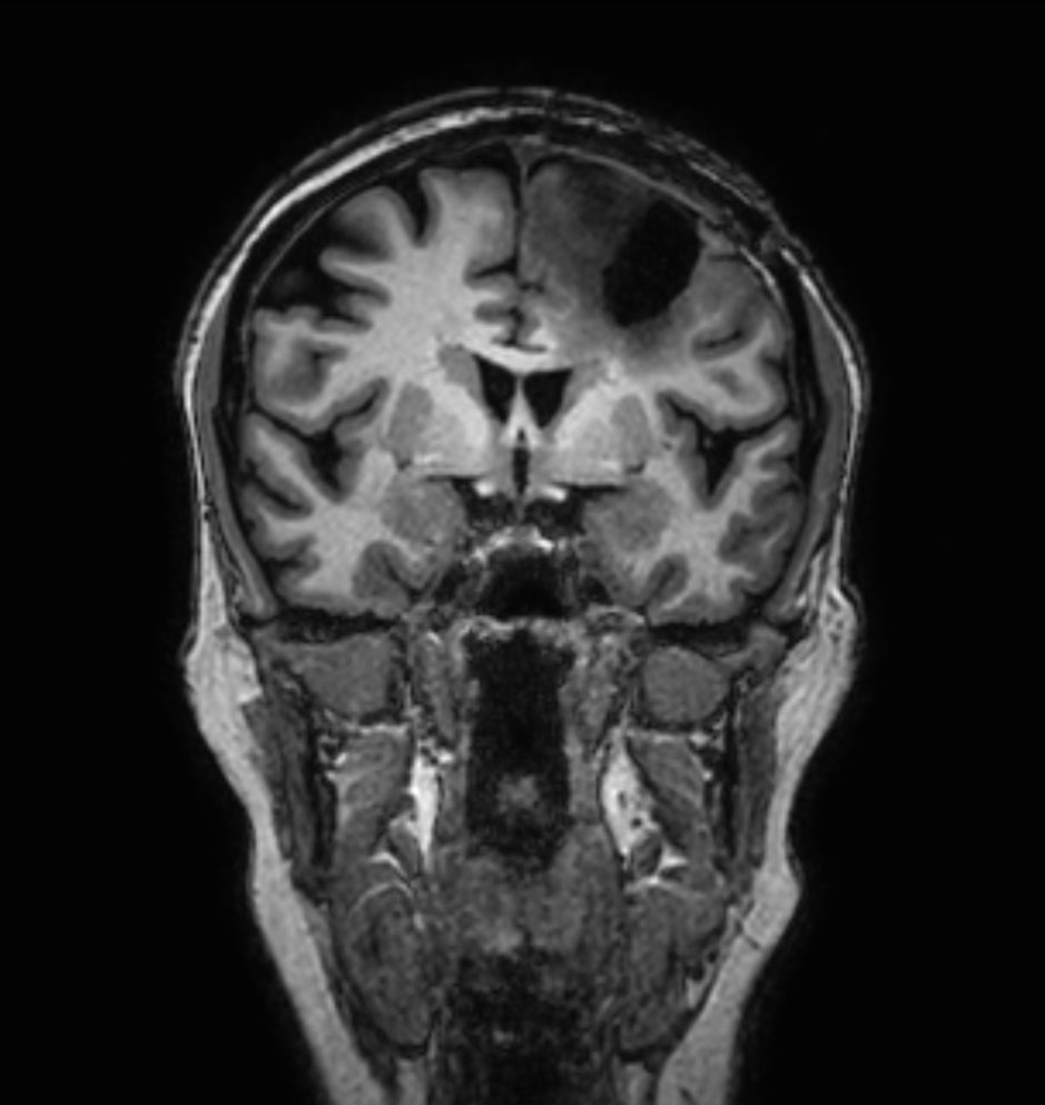3D T1w TFE - Coronal reformat